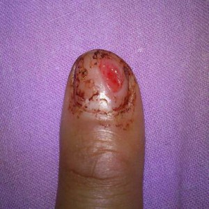 Premiären för höstterminen fick vänta efter en liten hacka-bort-nageln olycka.... 